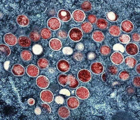 Two more mpox cases detected in the Philippines — .